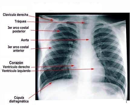 torax radiografía torax radiografía